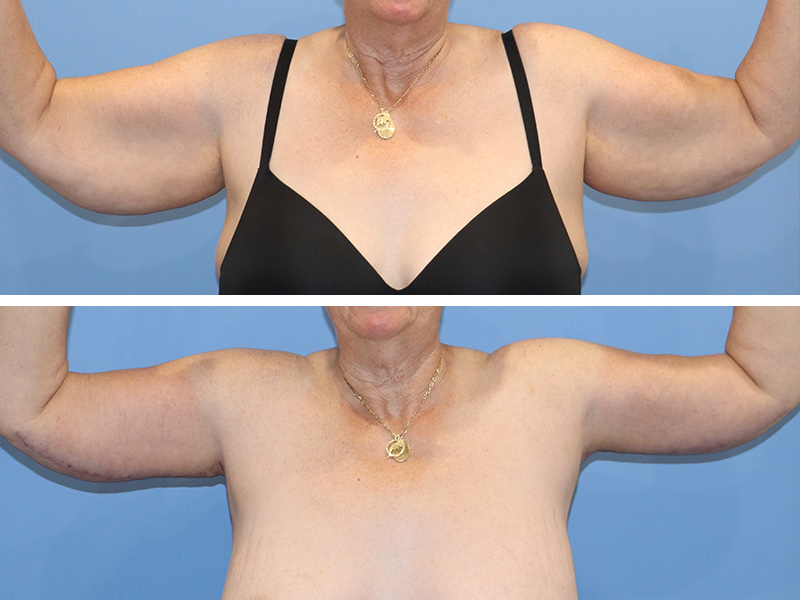 Arm lift Before & After Image