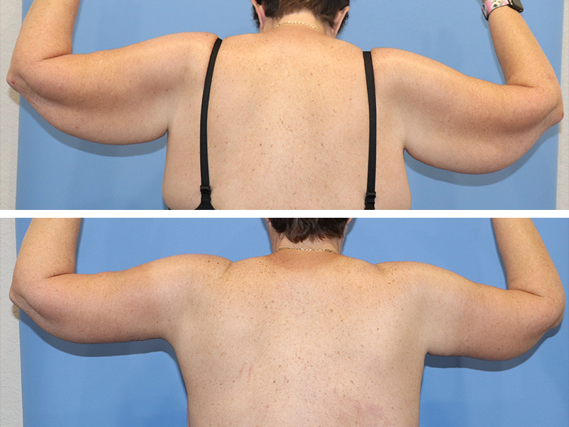 Arm lift Before & After Image