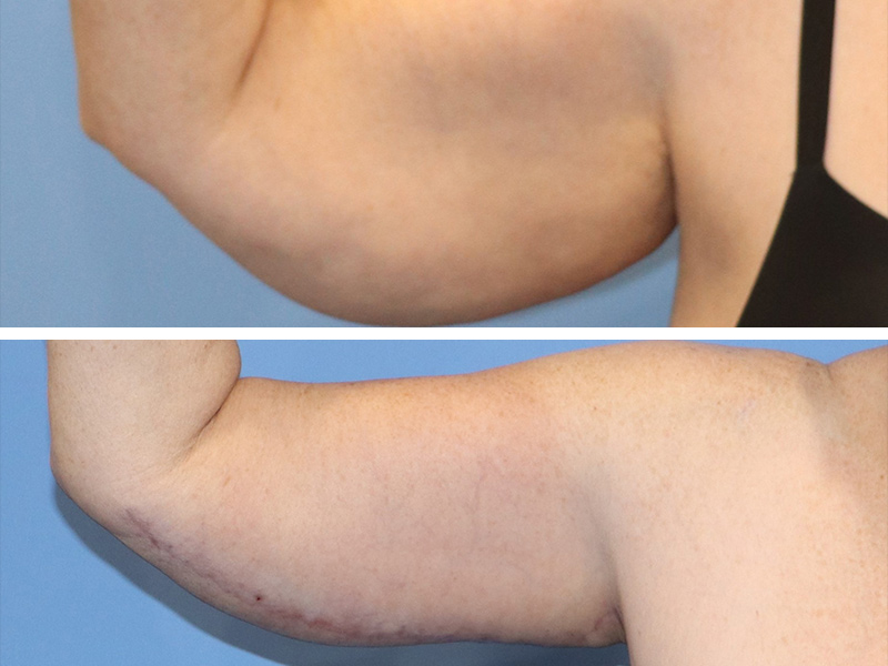 Arm lift Before & After Image