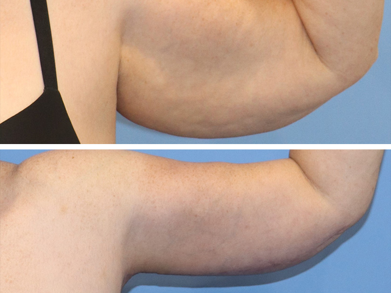 Arm lift Before & After Image