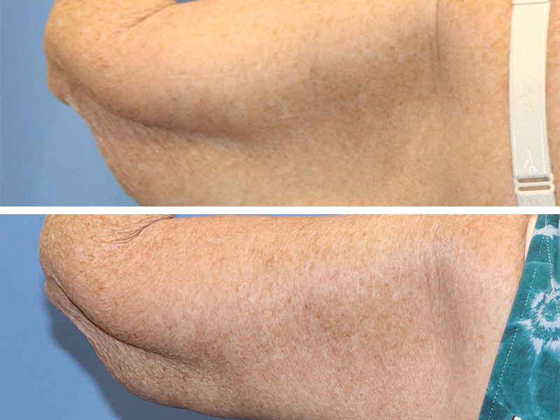 Arm lift Before & After Image