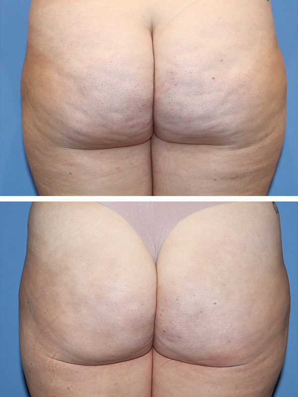 Aveli Cellulite Treatment Before & After Image