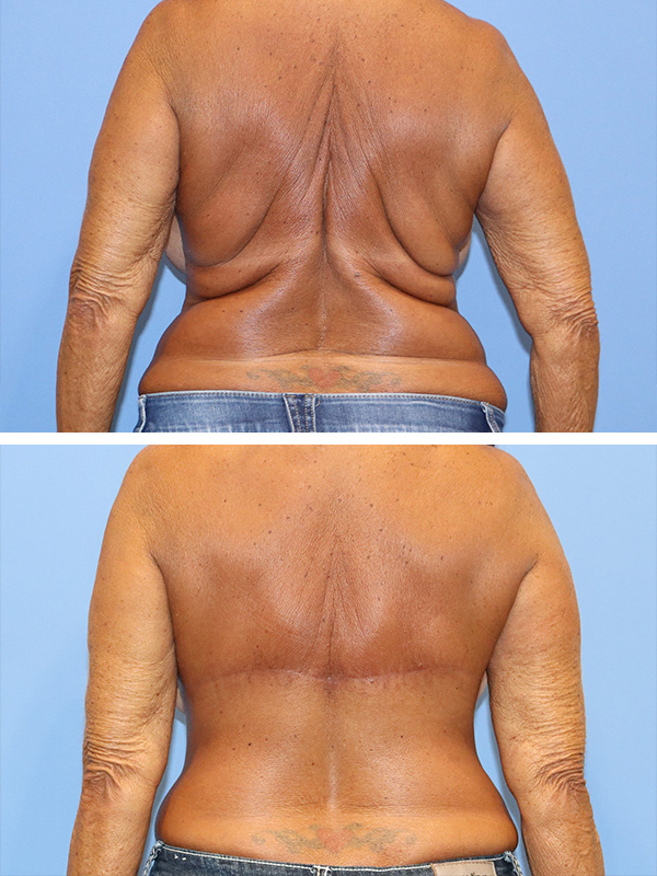 Back Lift (Thoracoplasty) Before & After Image