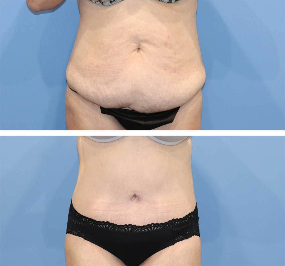 How Long Is Recovery After a Tummy Tuck? - Orlando FL - The Institute of  Aesthetic Surgery