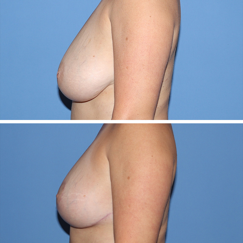 Breast Reduction Before & After Image