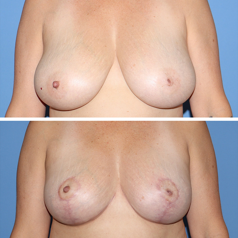 Breast Reduction Before & After Image