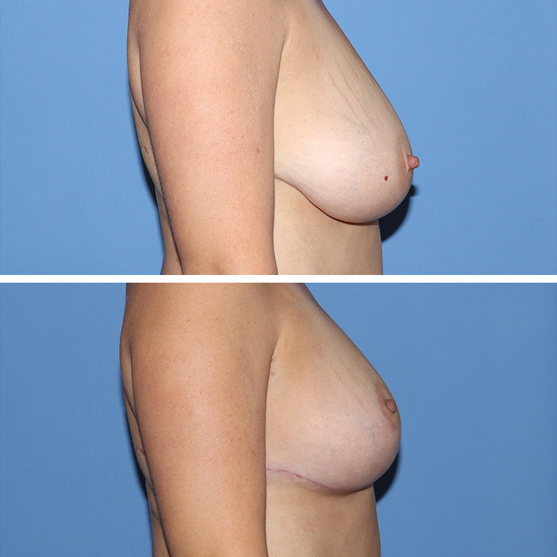 Breast Reduction Before & After Image