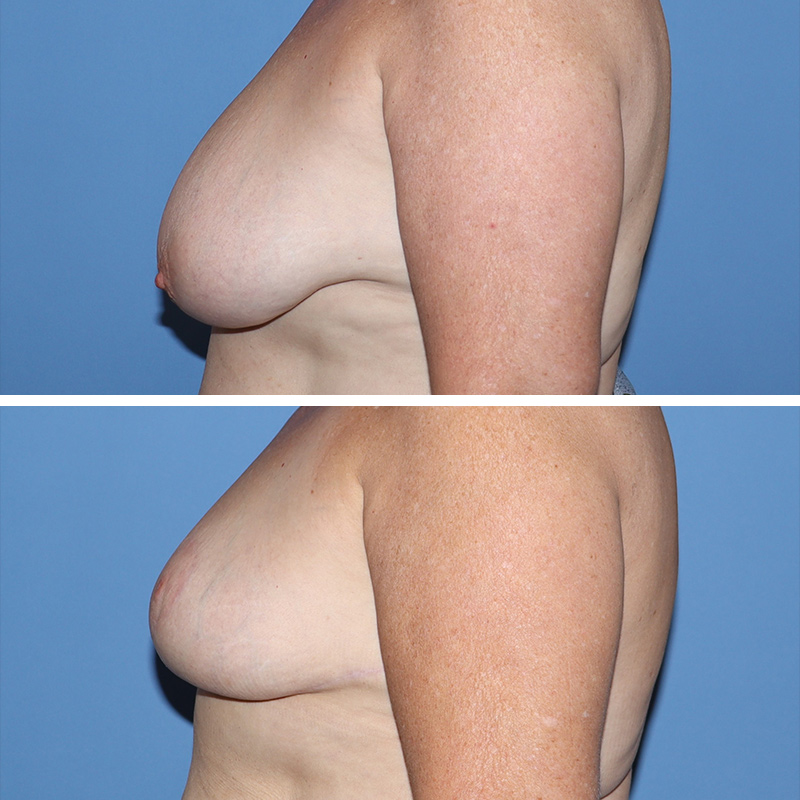 Breast Reduction Before & After Image