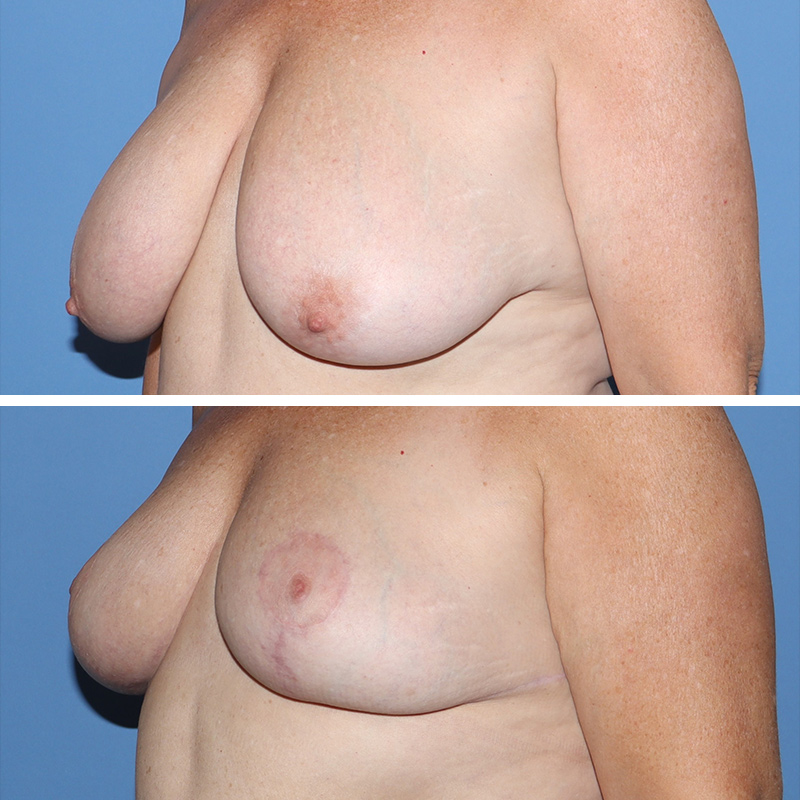 Breast Reduction Before & After Image