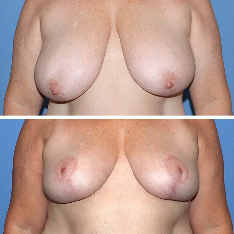 Breast Reduction Before & After Image