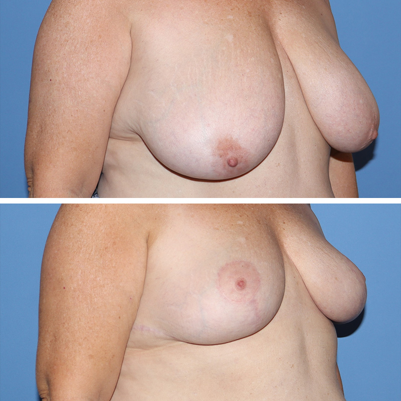 Breast Reduction Before & After Image