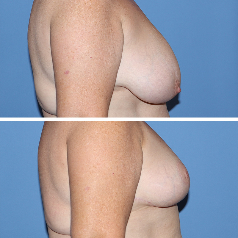 Breast Reduction Before & After Image