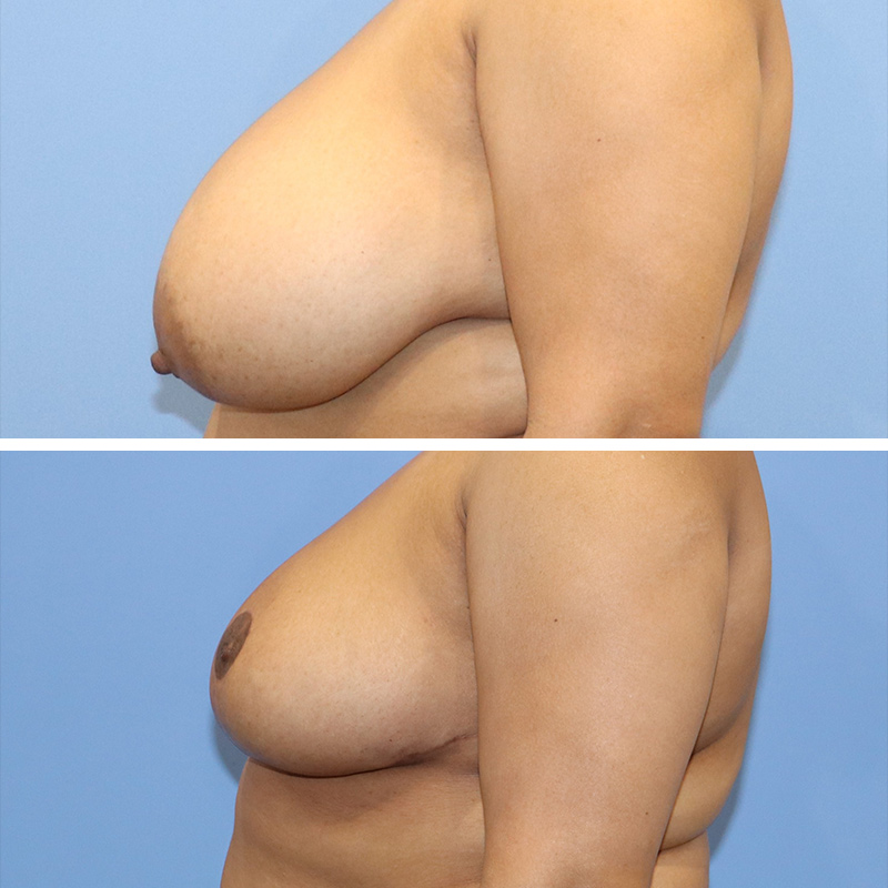 Breast Reduction Before & After Image