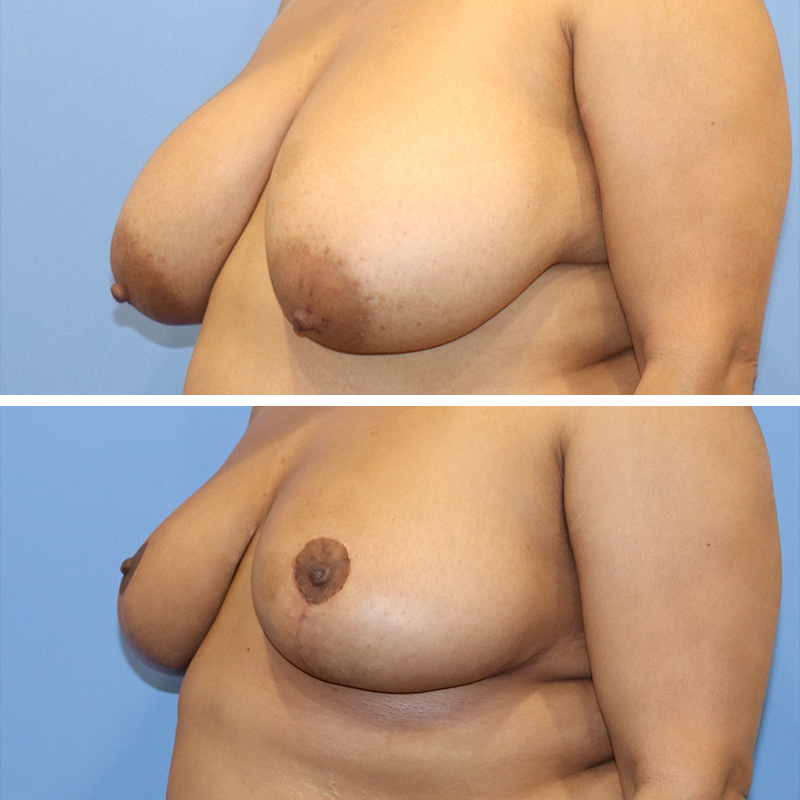 Breast Reduction Before & After Image