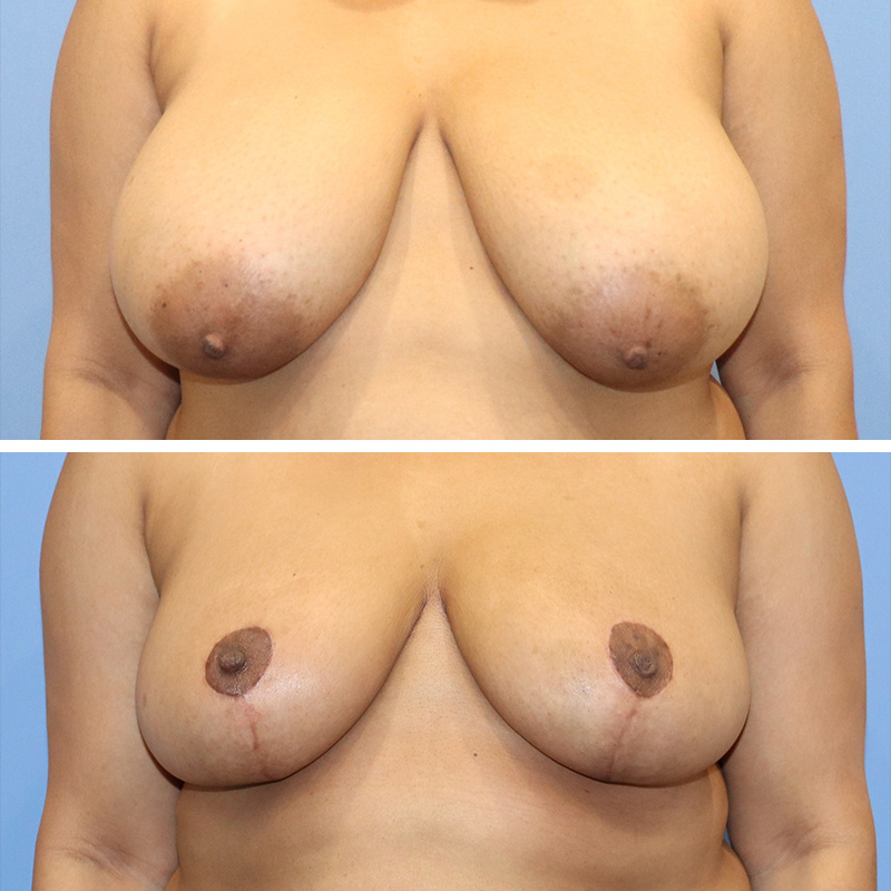 Breast Reduction Before & After Image