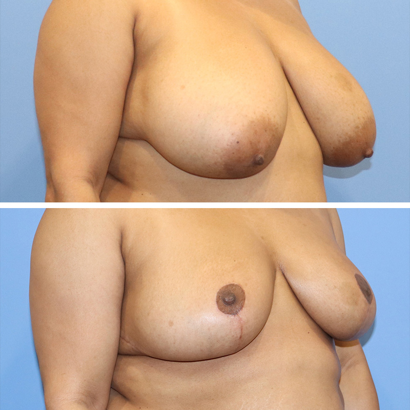 Breast Reduction Before & After Image