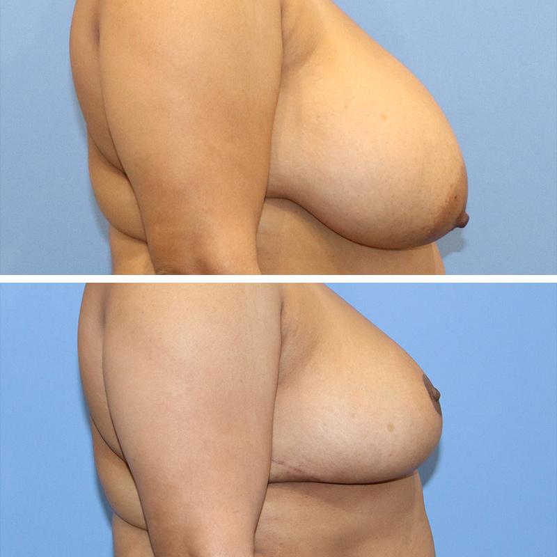 Breast Reduction Before & After Image