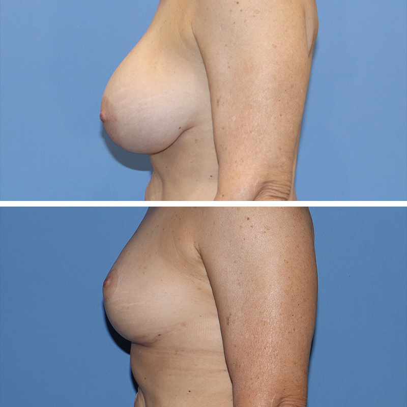 Implant Removal with Lift Before & After Image