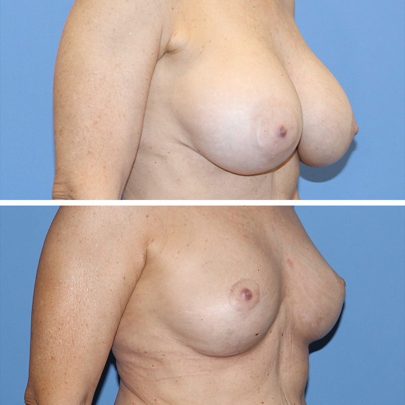 Implant Removal with Lift Before & After Image