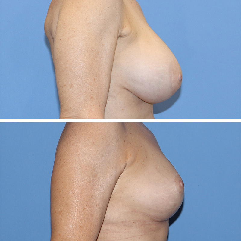 Implant Removal with Lift Before & After Image