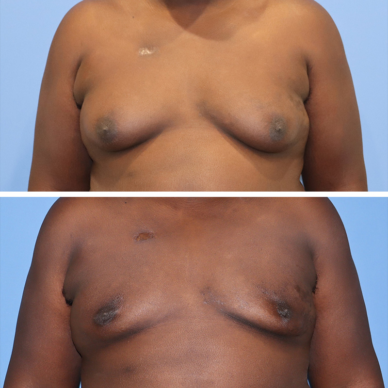 Male Breast Reduction Before & After Image