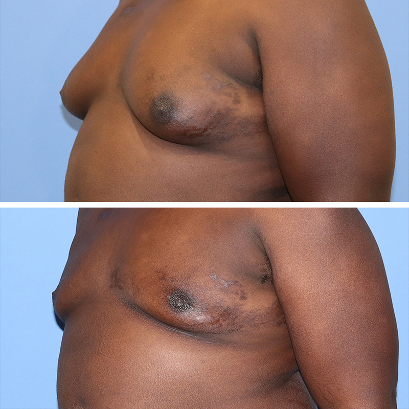 Male Breast Reduction Before & After Image