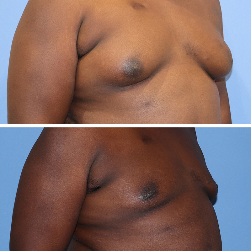 Male Breast Reduction Before & After Image