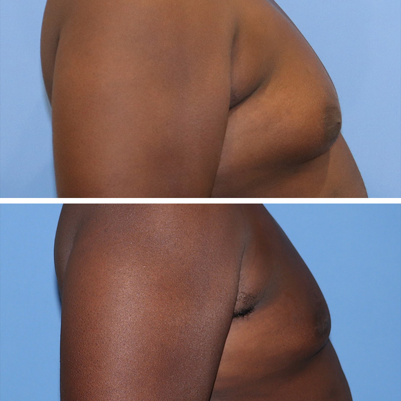 Male Breast Reduction Before & After Image