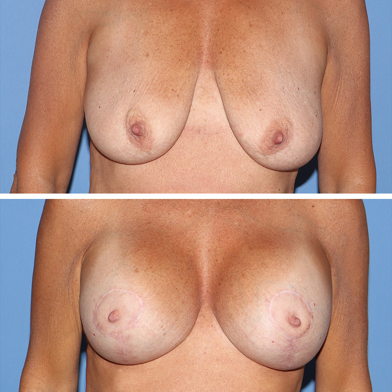 Mastopexy Before & After Image