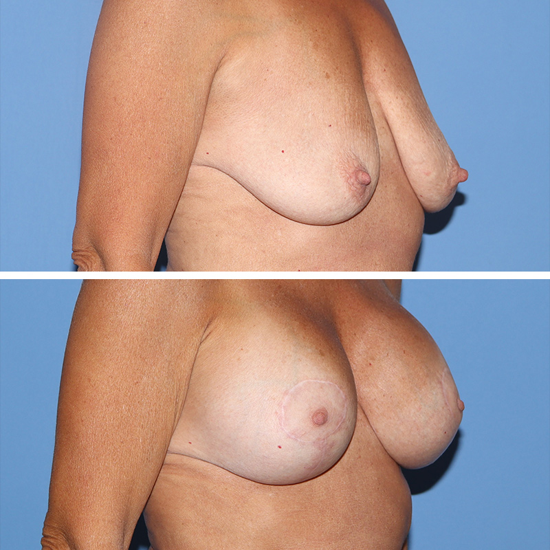 Mastopexy Before & After Image