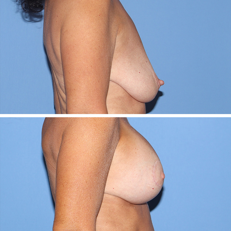 Mastopexy Before & After Image