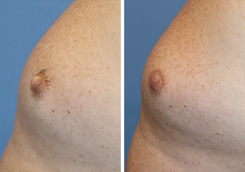 Nipple Reduction Before & After Image