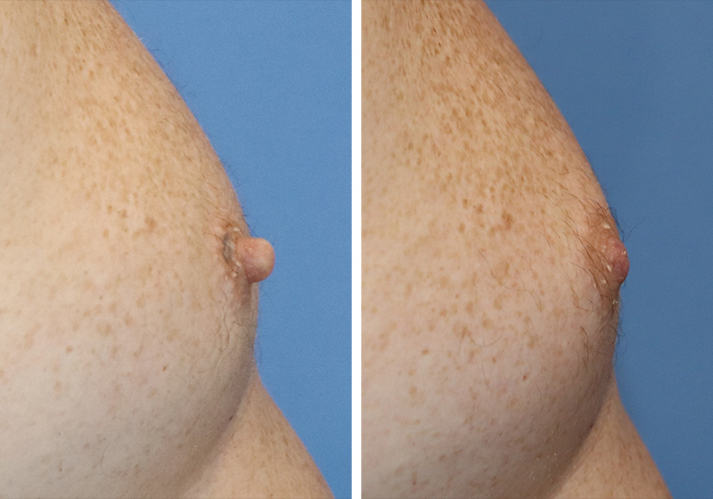 Nipple Reduction Before & After Image