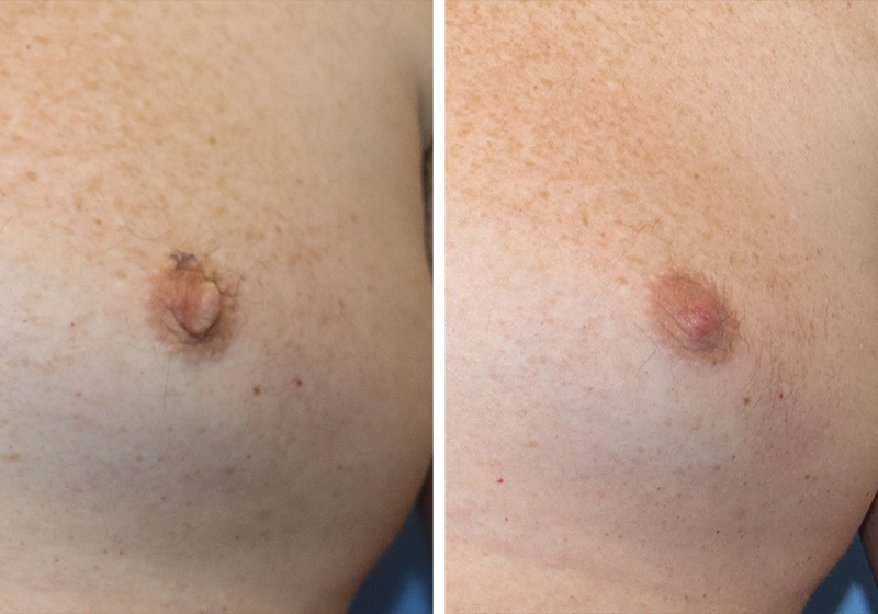 Nipple Reduction Before & After Image