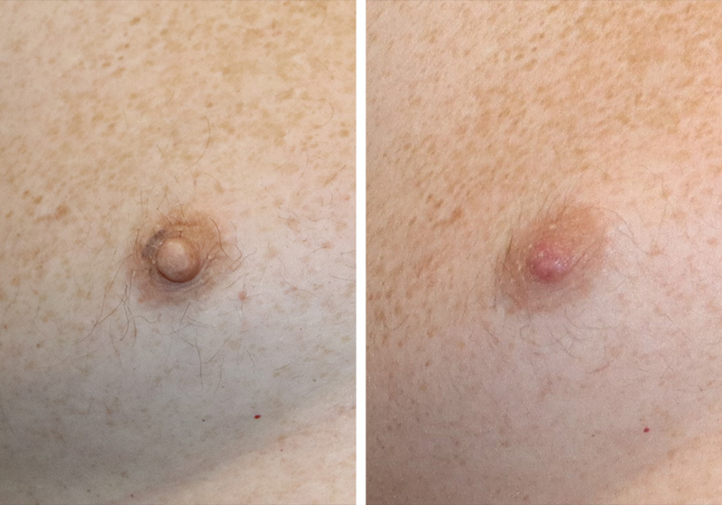 Nipple Reduction Before & After Image